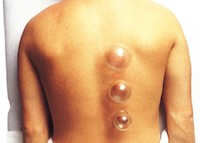 TCM cupping