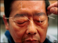 Image of acupuncture